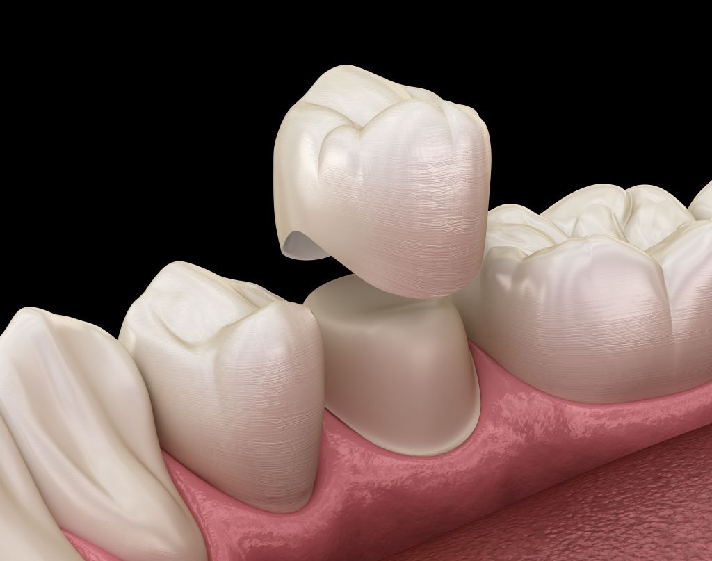 dental crowns in north toronto