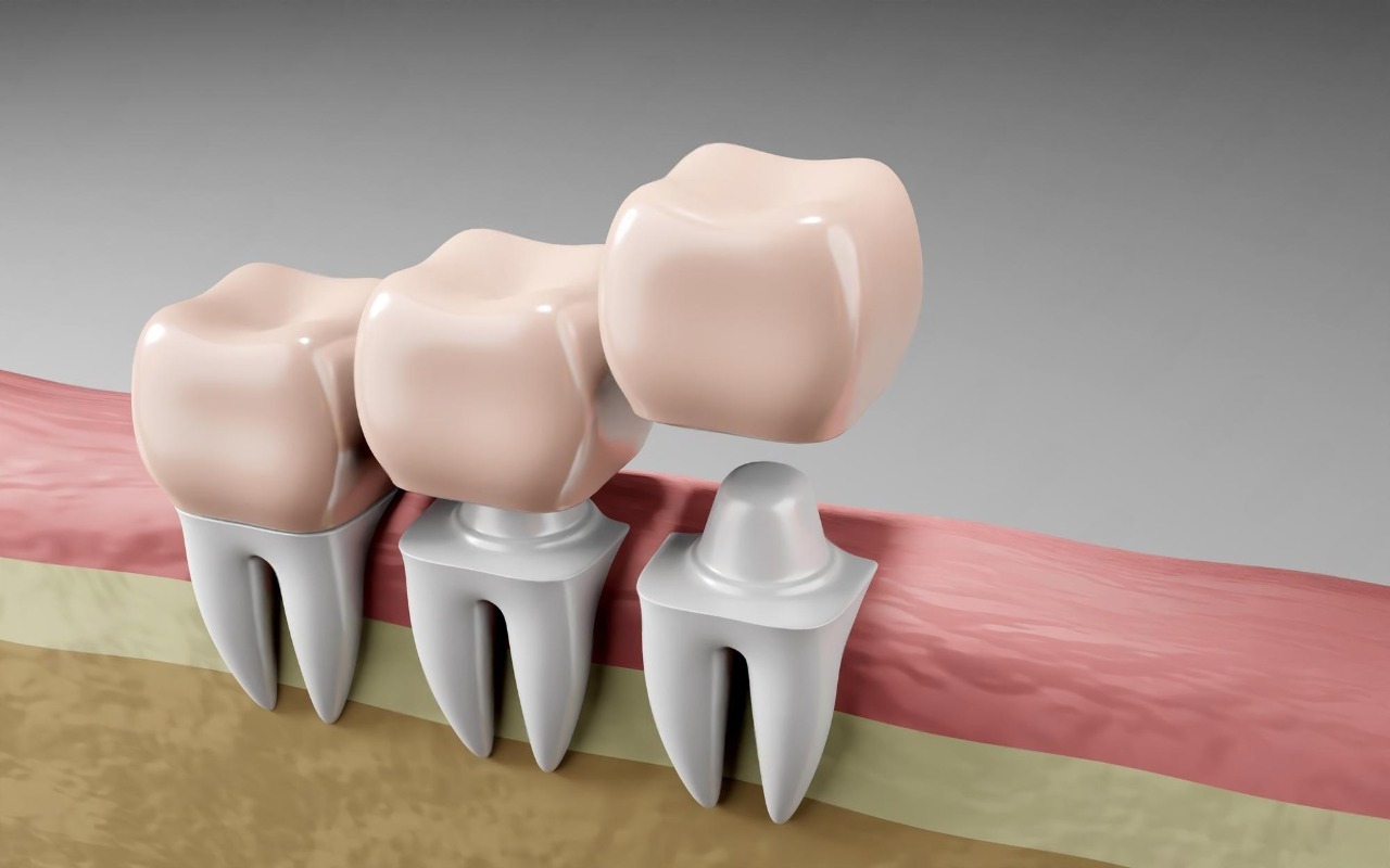 Dental crown in toronto