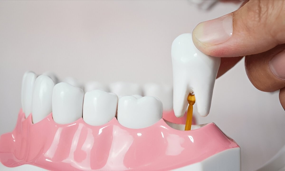 Wisdom Teeth Removal in Toronto