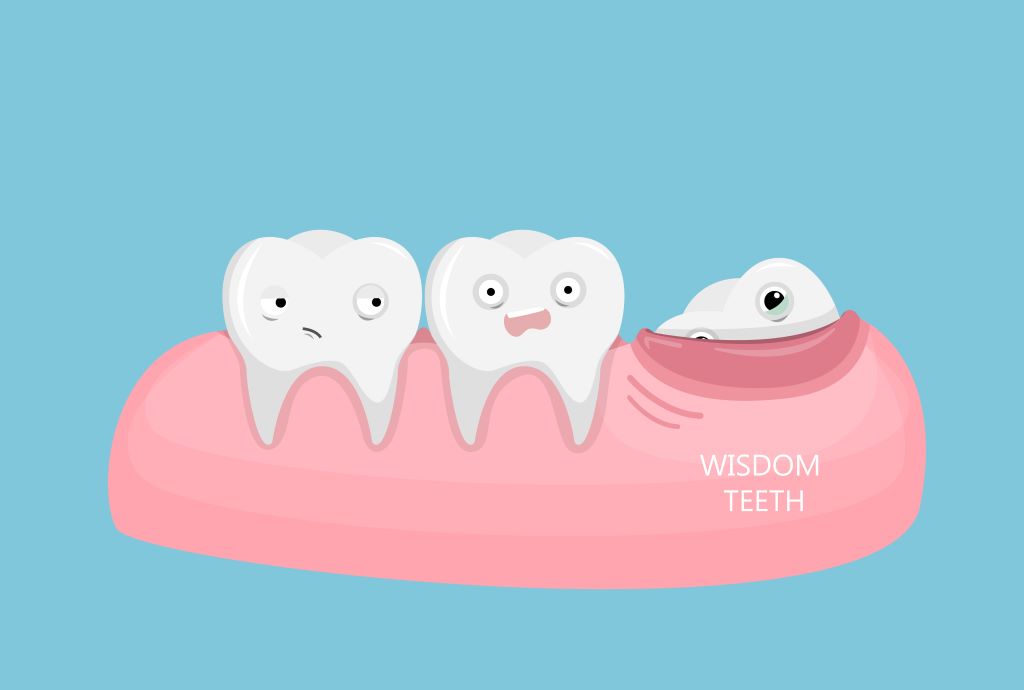 wisdom tooth removal
