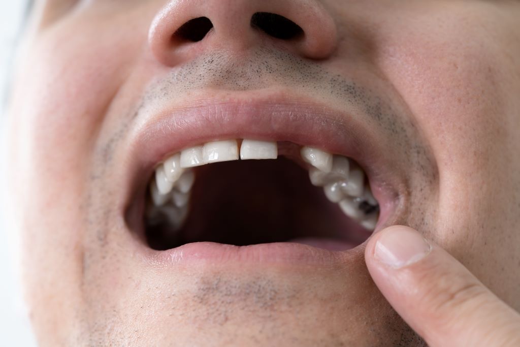 dental bridges in toronto