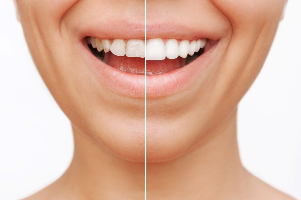 dental veneers in toronto