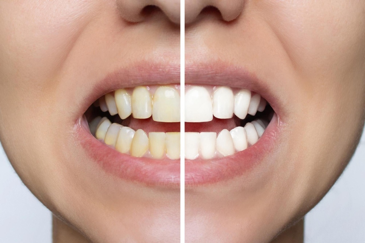 teeth whitening in toronto