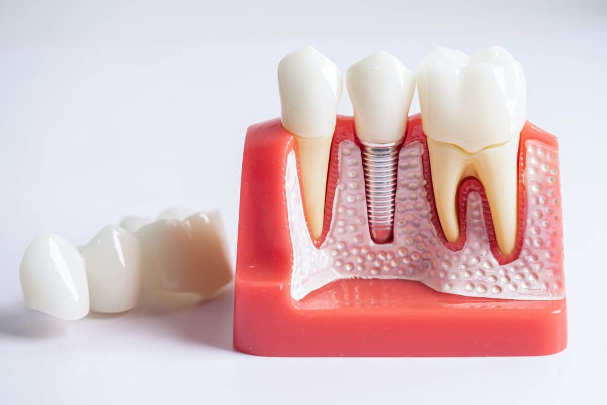 cost of dental implants in toronto