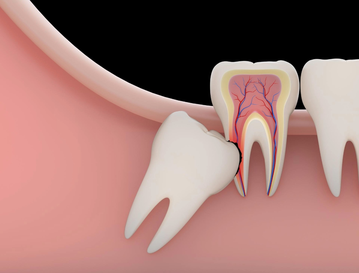 necessary to remove wisdom teeth and the cost