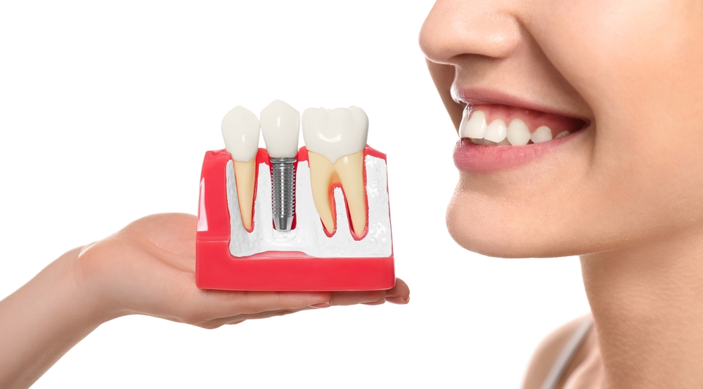 what is dental implants