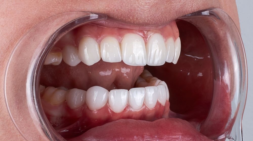 what is dental bonding, and what can dental bonding fix