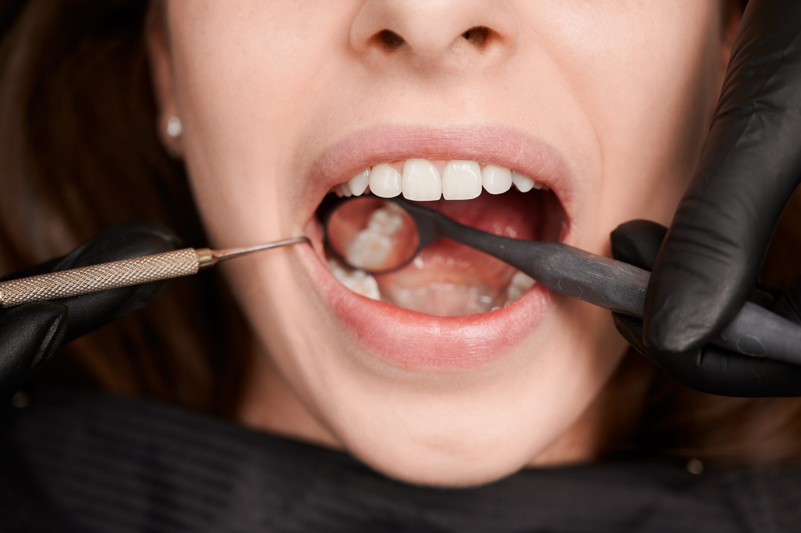 Composite fillings